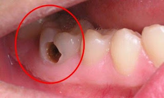 Sâu răng gây ra hôi miệng