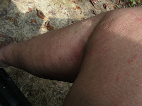 leg with larval tick bites