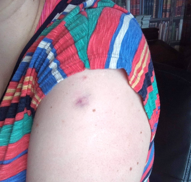 Picture of the bruise gained from the pfizer covid vaccination