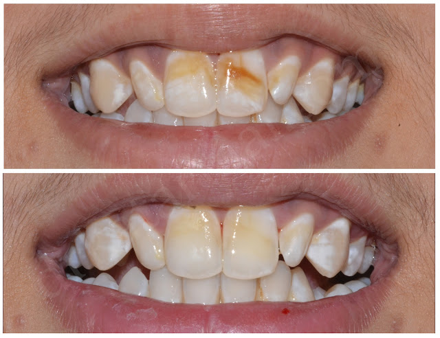 Dental Bleaching for Teeth Whitening for Dental Fluorosis