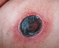 Medico en Formacion: MUCORMICOSIS (micosis profunda)