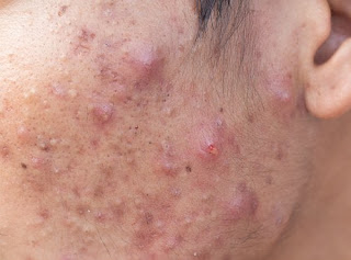 como quitar el acne de las mejillas