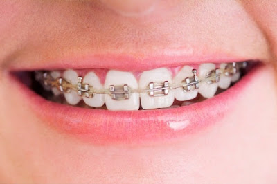 Niềng răng hô hàm trên có hiệu quả không? 2