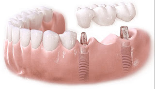 lưu ý khi cấy ghép implant