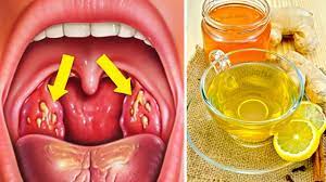Simply ways on How to Cure Tonsillitis in 4 Hours (Fast & Easy)