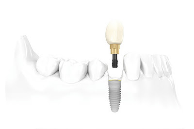 Thời gian sử dụng răng implant được bao lâu?