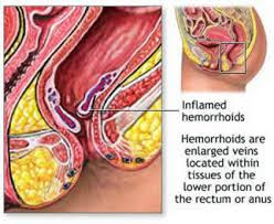 Wasir Pada Ibu Hamil