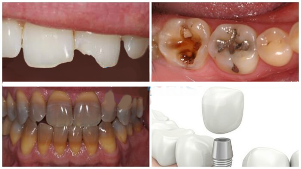 Bọc răng sứ phù hợp với hầu hết những trường hợp răng bị khiếm khuyết