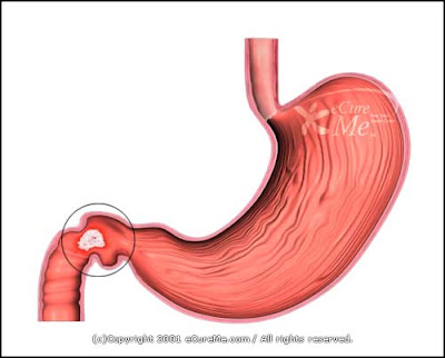 قرحة المعدة , الأسباب وطرق العلاج