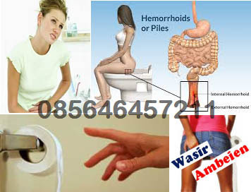 Tanda2 Penyakit Wasir (Hemoroid) Wanita