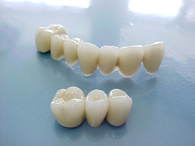 Răng sứ kim loại có mấy loại?