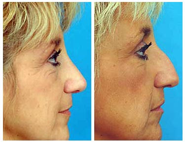 Nose Job Before And After