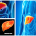 liver disease