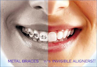 Chỉnh nha không mắc cài Invisalign