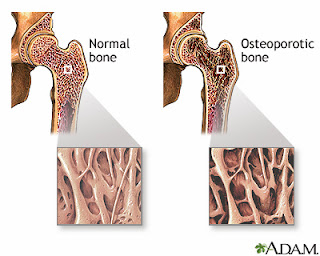 TULANG ANDA BERISIKO OSTEOPOROSIS