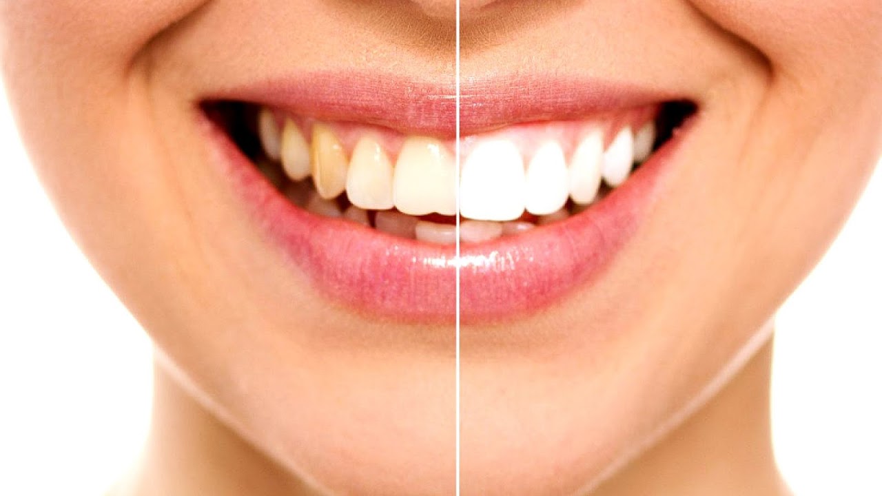 Getting Teeth Whitened Cost