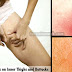 How To Get Rid Of Boils On Inner Thighs And Buttocks