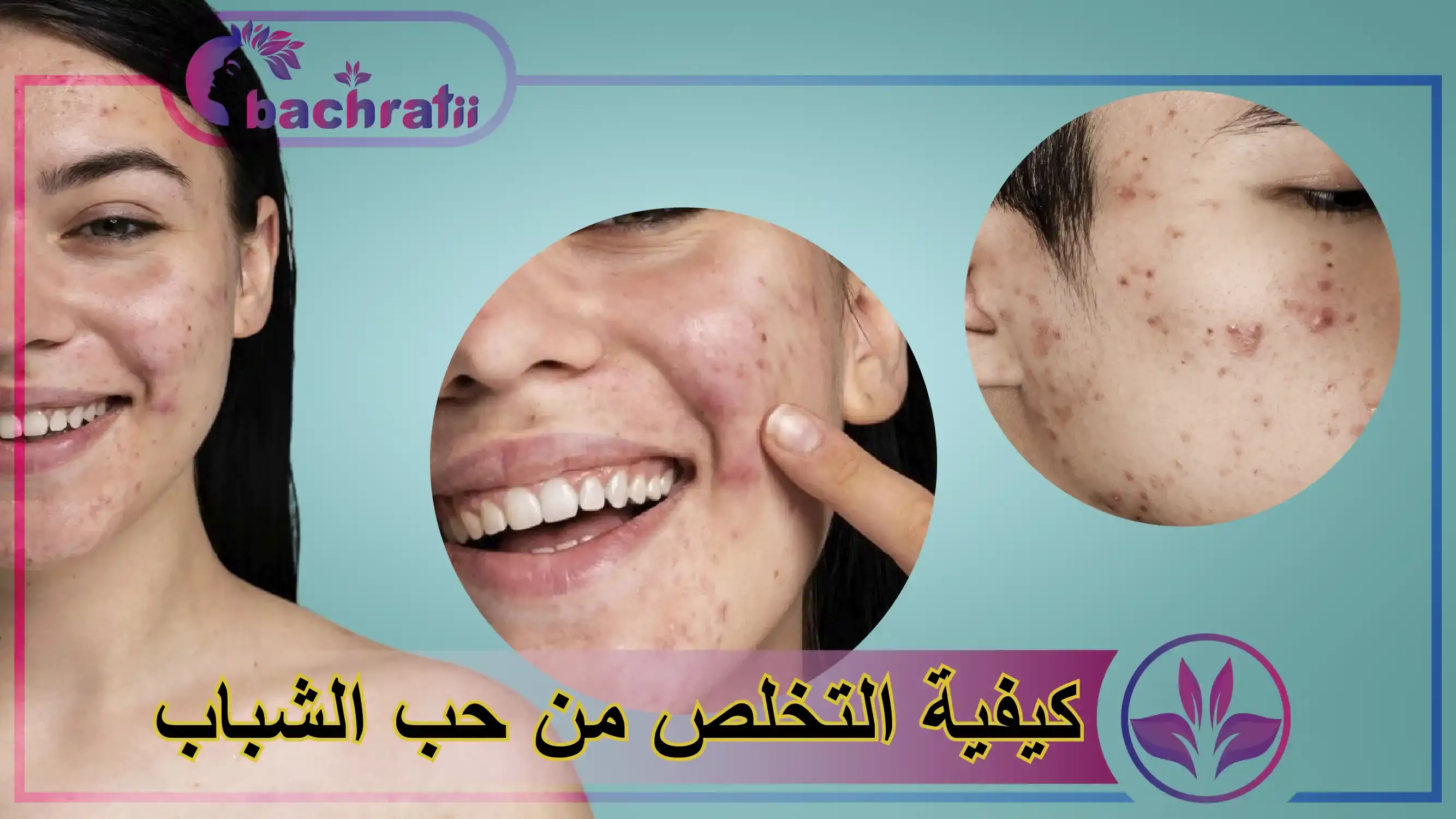 كيفية التخلص من حب الشباب