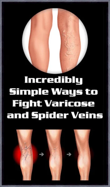 Incredibly Simple Ways to Naturally Fight Varicose and Spider Veins