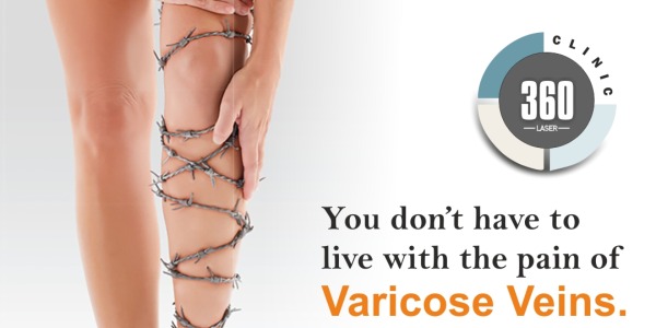 Varicose Veins Treatment Delhi