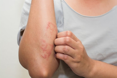 खाज खुजली(Scabies) का घरेलू इलाज khaj