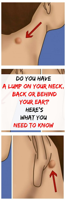 DO YOU HAVE A LUMP ON YOUR NECK, BACK OR BEHIND YOUR EAR? HERE’S WHAT YOU NEED TO KNOW