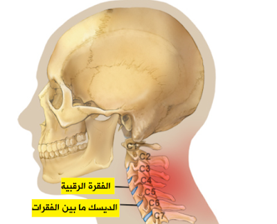 آلام الرقبة الحادة