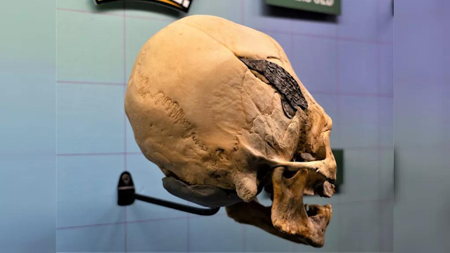 Unbelievable elongated skull from Peru with a metal implant patched inside the head of ancient Peruvian male.