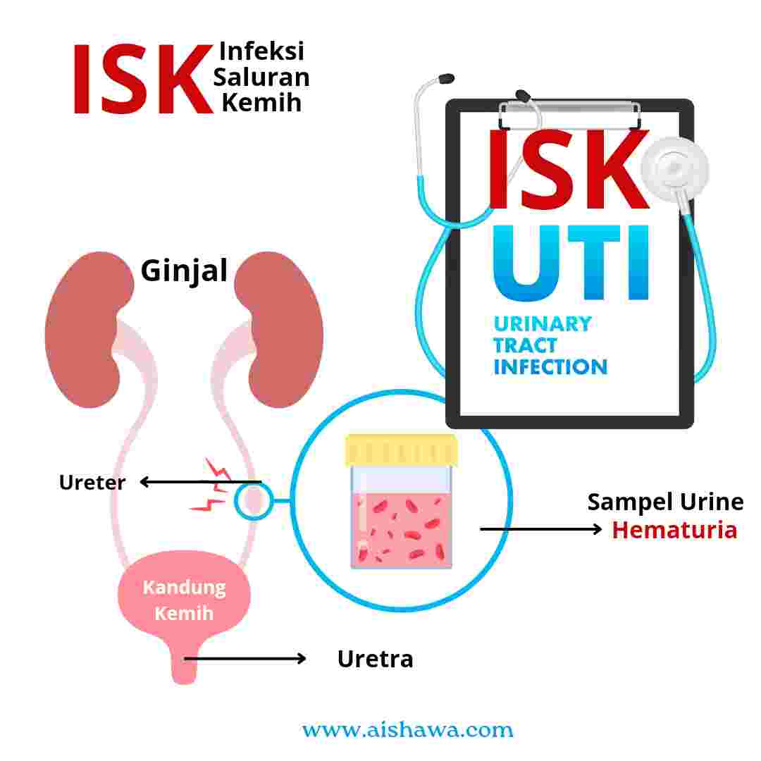 Hematuria