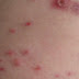 be careful the people who live in boarding schools are infected with scabies