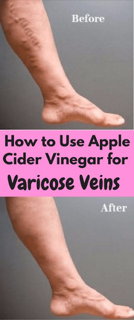 How to Use Apple Cider Vinegar for Varicose Veins