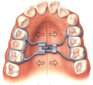 aparelho dentário, aparelho fixo, aparelho ortodôntico, diastema, disjuntor palatino, diário aparelho dentário, expansor fixo, expansor palatino, hirax, hyrax, mordida cruzada, ortodontia, 