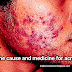 The cause and medicine for acne
