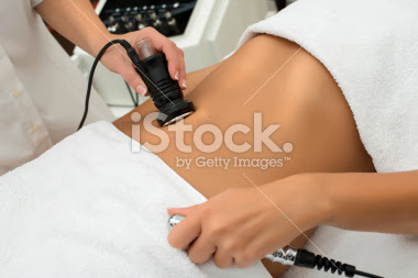 laser liposuction