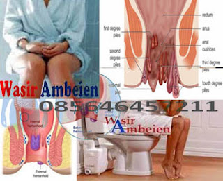 Apa AmbeJOSS Obat Wasir Ada Efek Sampingnya