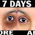 How To Remove Dark Circles Fast Only 1 Week 100% Effective