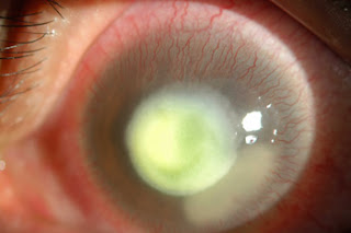 Infectious Keratitis