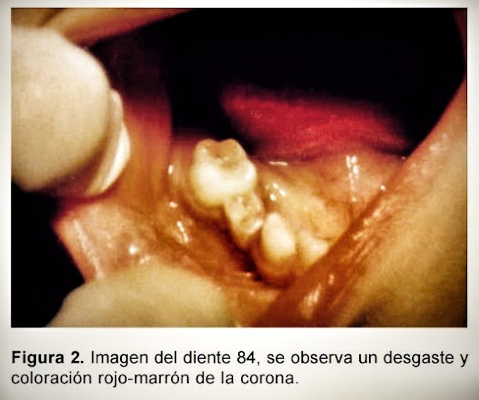 PDF: Reabsorción cementodentinaria externa: Reporte de un caso clínico