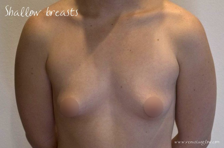 Venusian*Glow: Muscular Shallow Breasts Bra Metamorphosis: 32A to 28DD