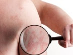Psoriasis: Not Eczema, Not Allergy
