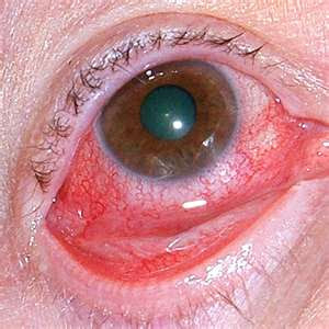 Red Eye Disease