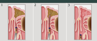 sinus operation