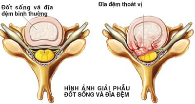 Lời khuyên cho người bị thoát vị đĩa đệm