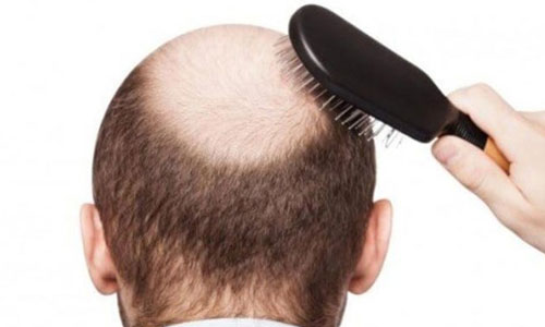 Cara Menumbuhkan Rambut Botak dengan Cepat dalam  Cara Menumbuhkan Rambut Botak dengan Cepat dalam 1 Minggu