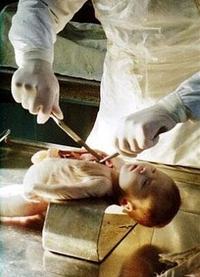 BLOG USANG: [ 10 gambar ] Gambar Post Mortem Bayi Di Bilik 