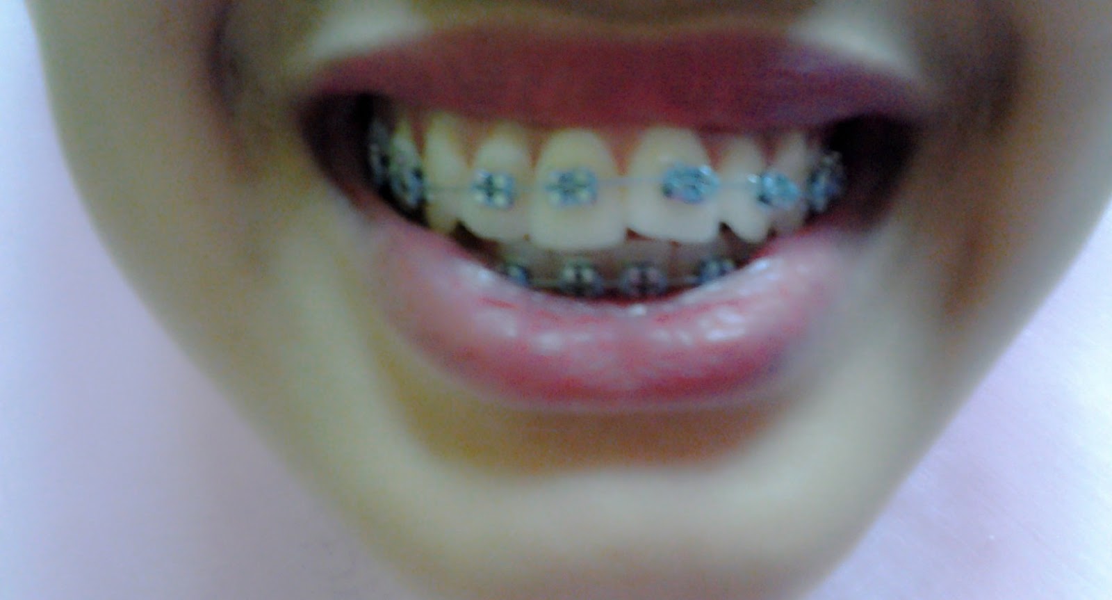 Mummy linda: Permulaan Memakai BRACES.