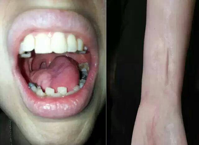 Woman loses tongue to cancer, gets new one made from her arm