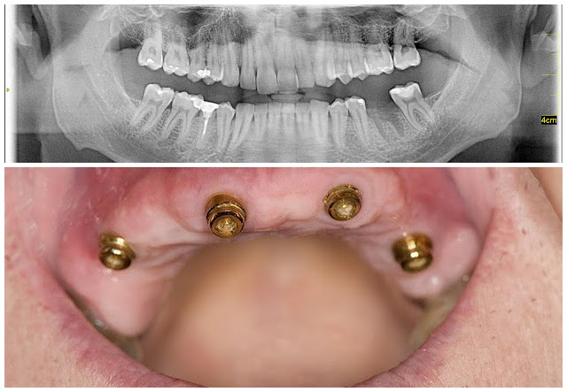 Implantes de dentes