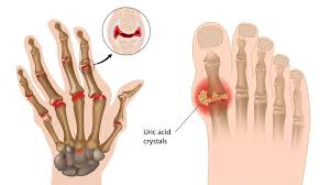 What is arthritis, causes and treatment 