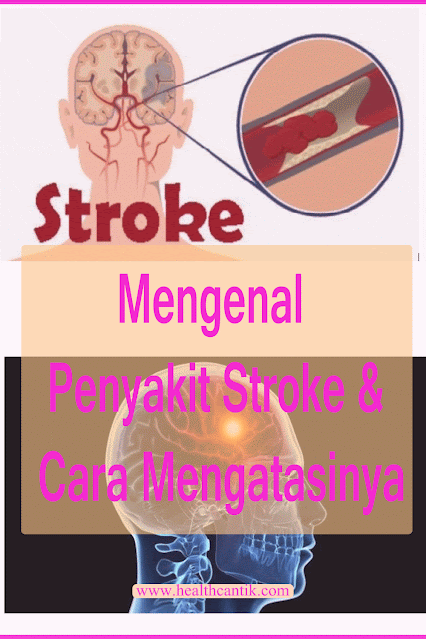 cara mengatasi penyakit stroke